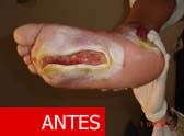 Tratamiento Oxigenacion Hiperb&aacute;rica Pie Diab&eacute;tico antes