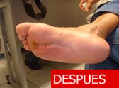 Tratamiento Oxigenacion Hiperb&aacute;rica Pie Diab&eacute;tico despu&eacute;s